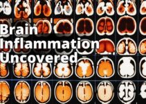 Exploring Brain Inflammation: Key Causes, Symptoms, And Treatment Insights
